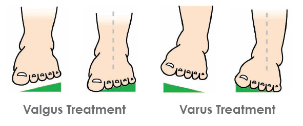 valgus heel wedge