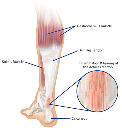 high achilles pain