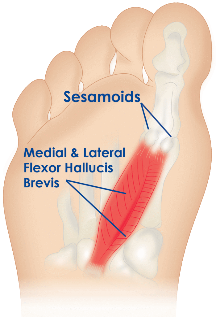 Sesamoiditis – ICB Medical